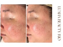 リオ(RIO)/肌育ピーリングで赤みケア初回