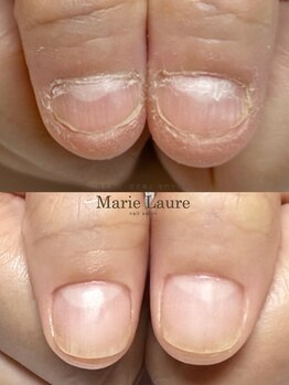 マリーロール 梅田店(Marie Laure)/自爪育成/深爪矯正/ネイルケア