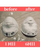 ロータス ビューティー(LOTUS Beauty)/石膏パックビフォーアフター