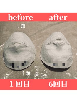 ロータス ビューティー(LOTUS Beauty)/石膏パックビフォーアフター