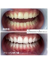 ホワイトニングサロン 京都烏丸店/ほわいとにんぐ施術例