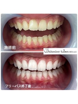 ホワイトニングサロン 京都烏丸店/ほわいとにんぐ施術例