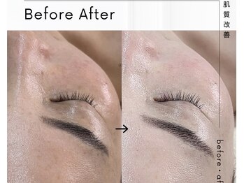 エミナル(EMINAL)/トーンアップメニュー