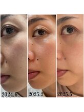 プラセル(Placer)/アラフォーのリアルその３/毛穴