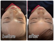 ことのは治療院/20代/頬のむくみ
