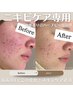 【ニキビケアNO.1】剥離あり◯肌質改善ハーブピーリング　¥19800→