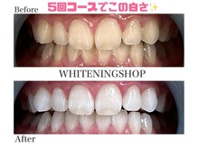 ホワイトニングショップ 名古屋店/【ビフォーアフター】5回コース