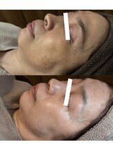 エステドルース(esthe de Ruth.)/肌改善　シミ