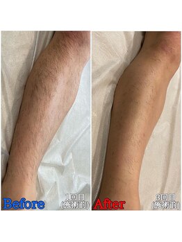 ファビー(Fabby)/メンズ脱毛★足のビフォアフ