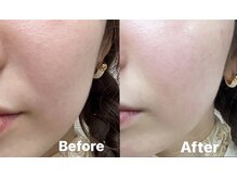 きらり 天神店/ヒト幹細胞ビフォーアフター