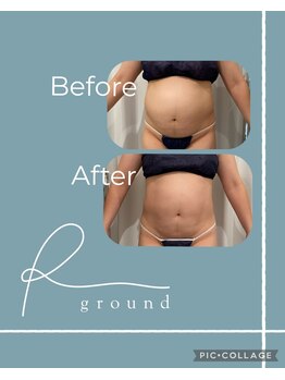 アールグランド 経堂店(R-ground)/全身痩せエンダモロジー×筋トレ