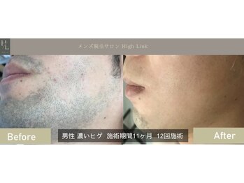 ハイリンク(High Link)/《ひげ脱毛》before→after
