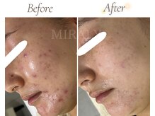 ミラリー(MIRALY)/敏感・ニキビケア 12ヶ月(20代)