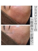 アースコアフュールボーテ ひたち野うしく店(EARTH coiffure beaute)/プラズマシャワーでニキビケア♪
