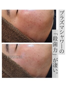 アースコアフュールボーテ ひたち野うしく店(EARTH coiffure beaute)/プラズマシャワーでニキビケア♪