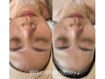 ソア/【美白】Christinaピーリング