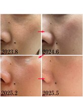 プラセル(Placer)/アラフォーのリアルその４/毛穴