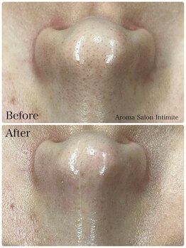 アンティミテ(Intimite)/毛穴洗浄1回の変化