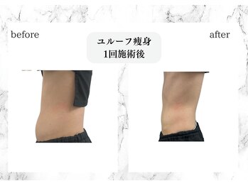 トキ(TOKI)/ユルーフ超音波痩身 お腹