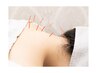 人気NO.1/鍼打ち放題【首肩こり・頭痛改善コース】90分/￥12,980→￥8,980