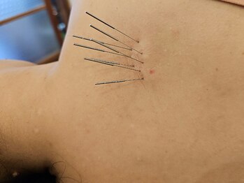 はりきゅう和 ルート鍼灸院/背中の痛み（肩甲骨の間）