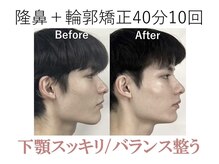 ラプリ 梅田店(Raplit)/隆鼻＋輪郭矯正40分10回