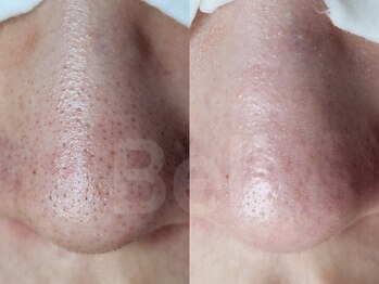 脱毛サロン ベル(Bell)/毛穴すっきりフェイシャル