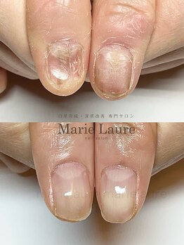 マリーロール 梅田店(Marie Laure)/自爪育成/深爪矯正/ネイルケア