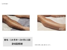 トータルクリア(TOTAL CLEAR)/男性脚脱毛