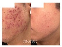 モネ(monet)/グリーンピール5days