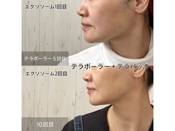 TCM-y...の写真/夏までのキャンペーン！