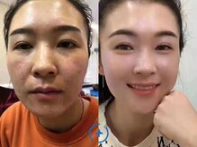 ステップイン(Step in)/小顔コース&化粧品使用