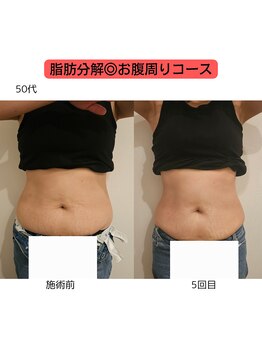 ウル バイ ラシック(Ulu by Lasic)/【脂肪分解】上半身ダイエット◎