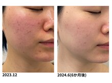 オーシャンブルー 佐世保店(OCEAN BLUE)の雰囲気（ニキビケア、毛穴ケア、シミケアなどお肌のお悩みも解決します！）