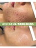 【ニキビ.くすみ.開き.凹凸.ざらつき一気改善】ハーブピーリング19500→16500