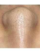 【Before】エステ前