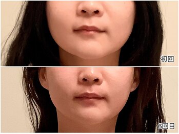 エムベル(M.belle)/リフトアップマッサージ6回目