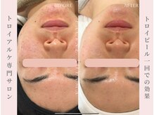 ファシネアオヤマ(FACINE AOYAMA)/トロイピールのお肌変化！