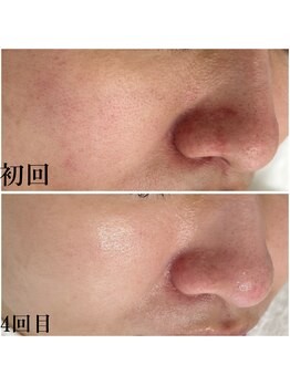 プラセル(Placer)/毛穴ケアは専門サロンへお任せ☆