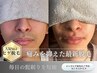 【メンズ脱毛｜ヒゲ脱毛】人気No.1毎日の髭剃り-10分。痛みを抑えた最新脱毛