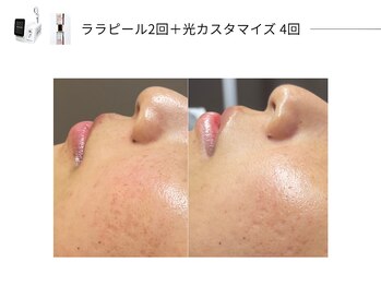 スパレーカ(Spa laka)/光カスタマイズ＋ララピール