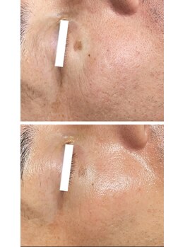 武蔵小杉リンパサロン かおりの部屋/水光ボツリヌスフェイシャル