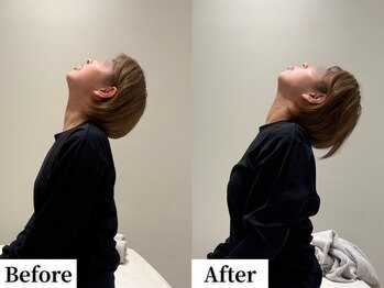 ソレア(Solea)/肩こり改善1回目