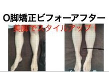 やち鍼灸院/O脚矯正で美脚に！