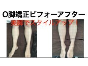 やち鍼灸院/O脚矯正で美脚に！