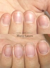 マリーロール 梅田店(Marie Laure)/自爪育成/深爪矯正/ネイルケア