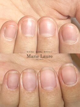 マリーロール 梅田店(Marie Laure)/自爪育成/深爪矯正/ネイルケア