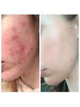 フォフォ 仙台泉店(Fofo)/話題の韓国式ハーブピーリング