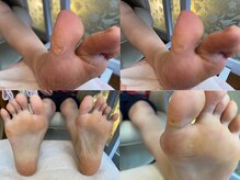 ビサンテ サロン/フットケアの角質ケア・魚の目-2