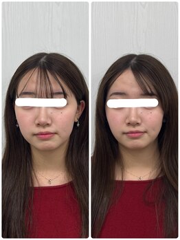 ラフテル鍼灸整骨院/美容鍼×小顔整体！